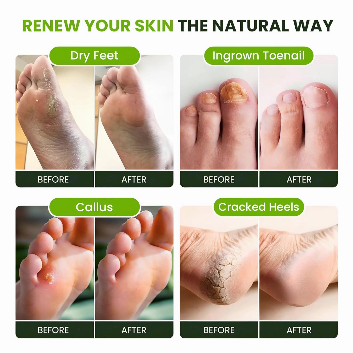 Tea Tree Oil Foot Soak with Epsom Salts- for Foot Pain, Soreness, Athletes Foot, Odors, Toe Nail Fungus, Fungal, Calluses Made in USA - 4 Pack